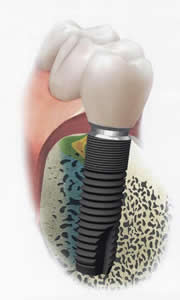 �C���v�����g