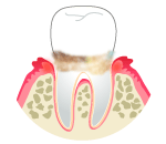 �����a�̏Ǐ�i�y�x�j