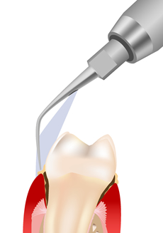 �����g�X�P�[���[